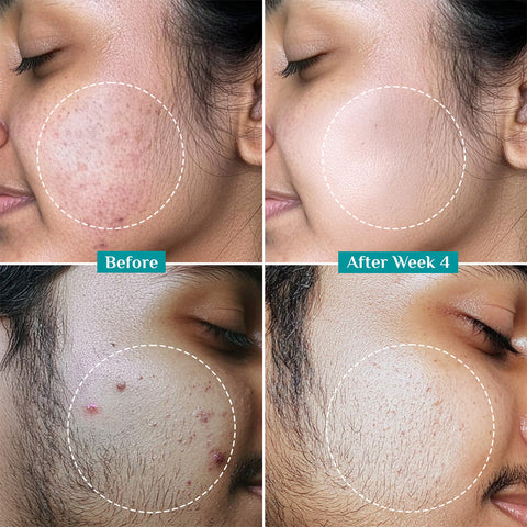 سيروم بيلجريم المضاد لحب الشباب 30 مل