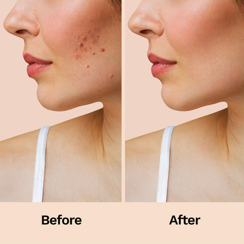 Pee Safe Furr Hydrocolloid Acne Relief Patch 12S